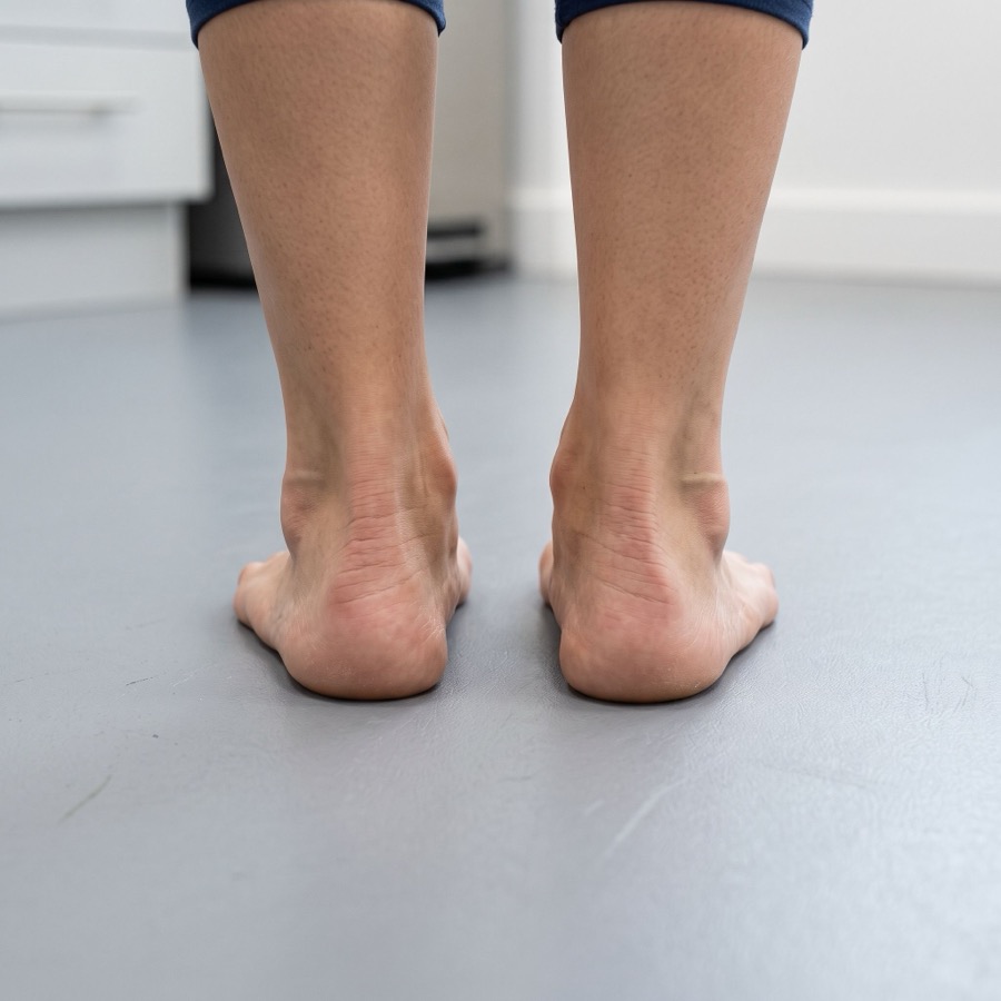 Flat Feet