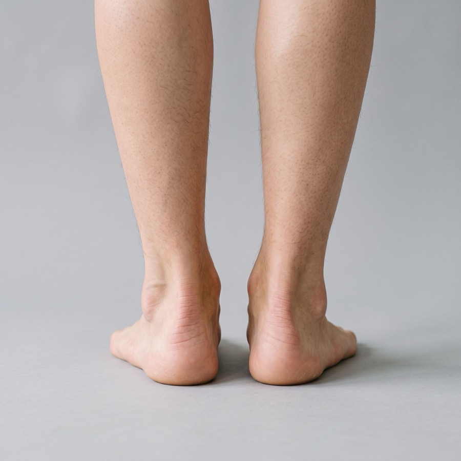 Overpronation
