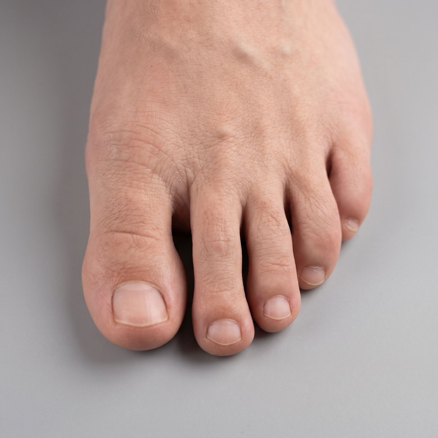 Morton's Neuroma