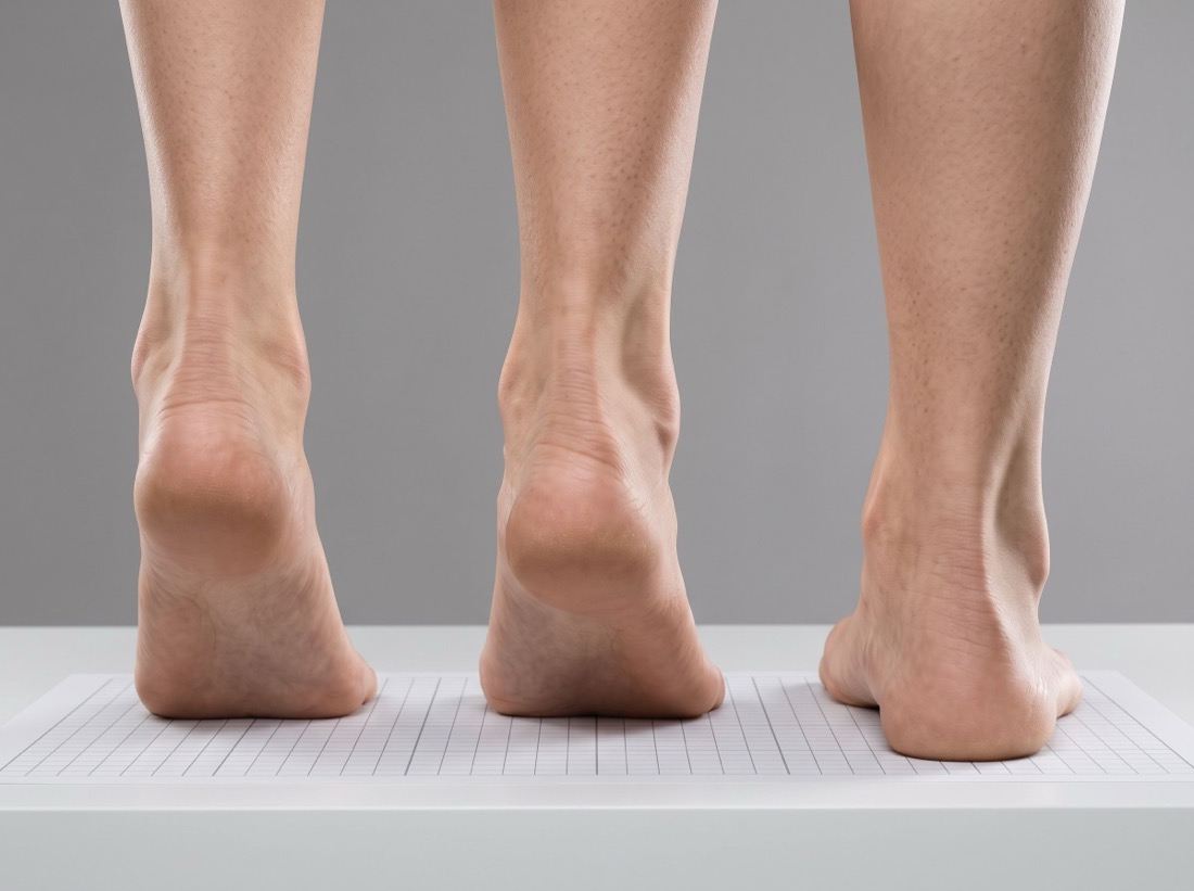 Three foot arch types shown from behind: high, neutral, and flat arch